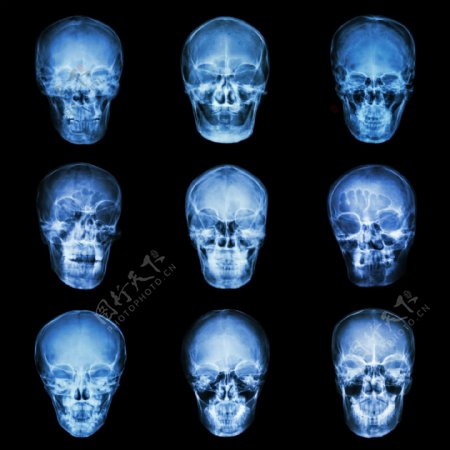 大脑X光片图片