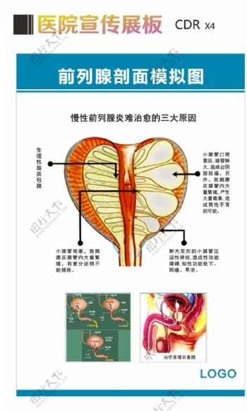 前列腺剖面模拟图