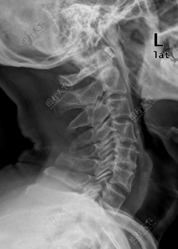 颈侧位骨科医生x光图片