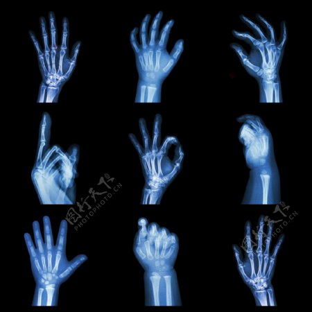 手部X光片图片